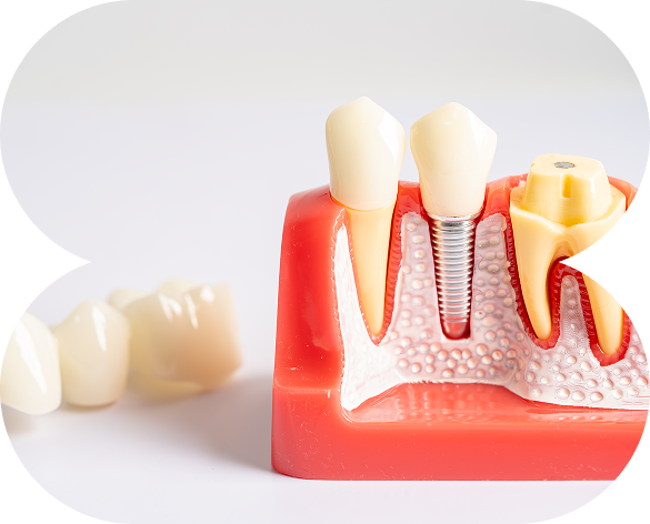 Dental Implants
