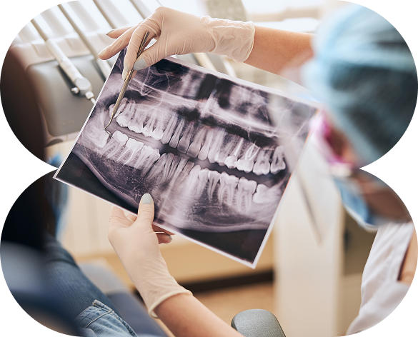 Wisdom Teeth Removal